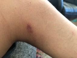 sore on the inside part of my knee where my prosthesis rubs when I run